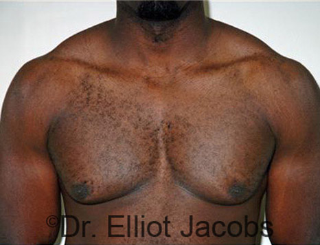 Men's breast, before Gynecomastia treatment in Bodybuilders, front view - patient 17