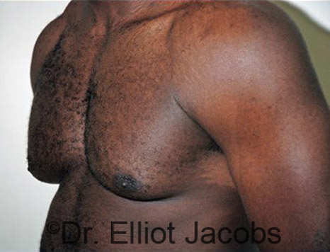 Men's breast, before Gynecomastia treatment in Bodybuilders, oblique view - patient 17