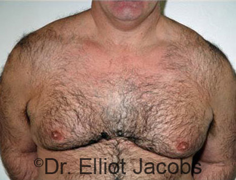 Men's breast, before Gynecomastia treatment in Bodybuilders, front view - patient 18