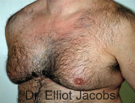 Men's breast, before Gynecomastia treatment in Bodybuilders, oblique view - patient 18