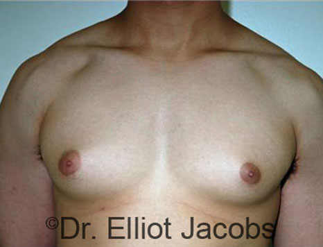 Men's breast, before Gynecomastia treatment in Bodybuilders, front view - patient 19