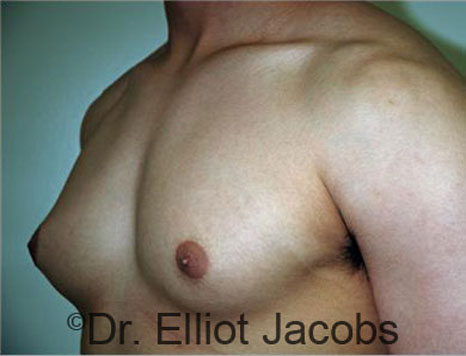 Men's breast, before Gynecomastia treatment in Bodybuilders, oblique view - patient 19
