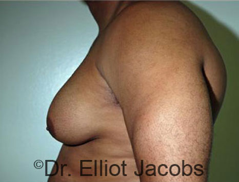 Men's breast, before Gynecomastia treatment in Bodybuilders, oblique view - patient 20