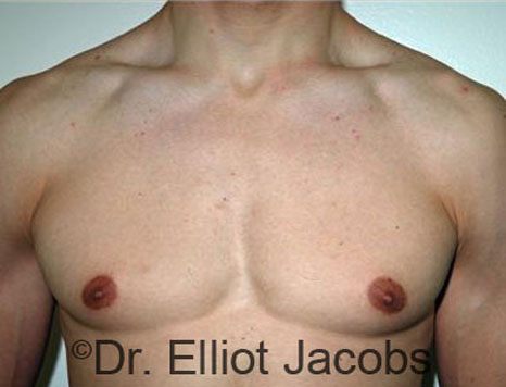 Men's breast, before Gynecomastia treatment in Bodybuilders, front view - patient 21
