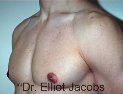 Men's breast, before Gynecomastia treatment in Bodybuilders, oblique view - patient 21