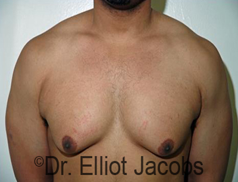 Men's breast, before Gynecomastia treatment in Bodybuilders, front view - patient 22