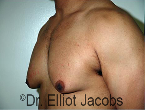 Men's breast, before Gynecomastia treatment in Bodybuilders, oblique view - patient 22