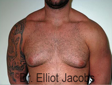 Men's breast, before Gynecomastia treatment in Bodybuilders, front view - patient 23