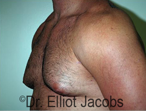 Men's breast, before Gynecomastia treatment in Bodybuilders, oblique view - patient 23
