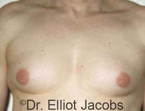 Male breast, before Gynecomastia treatment, front view, patient 13