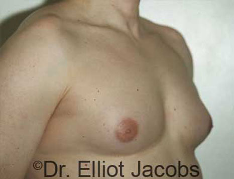 Male breast, before Gynecomastia treatment, r-side oblique view - patient 13