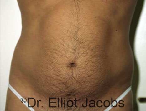 Male body, before Torsoplasty treatment, front view - patient 2