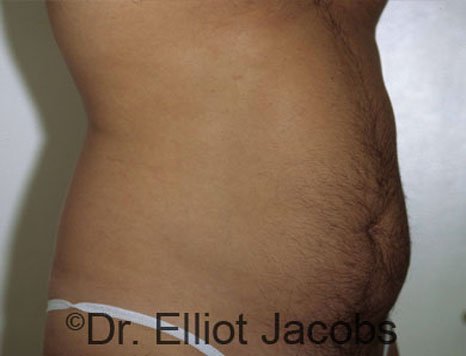 Male body, before Torsoplasty treatment, r-side oblique view, patient 1