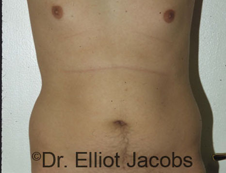 Male body, before Torsoplasty treatment, front view, patient 2