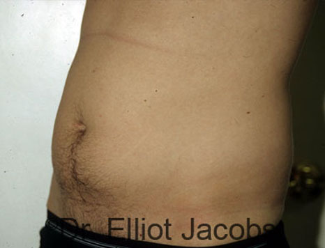 Male body, before Torsoplasty treatment, l-side oblique view, patient 2