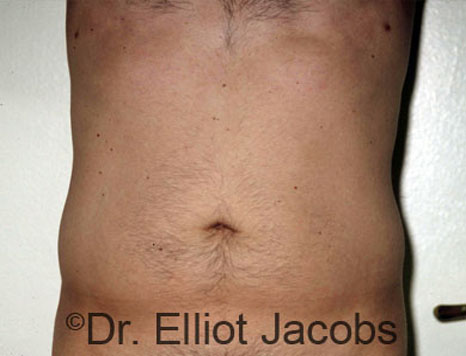 Male body, before Torsoplasty treatment, front view, patient 3