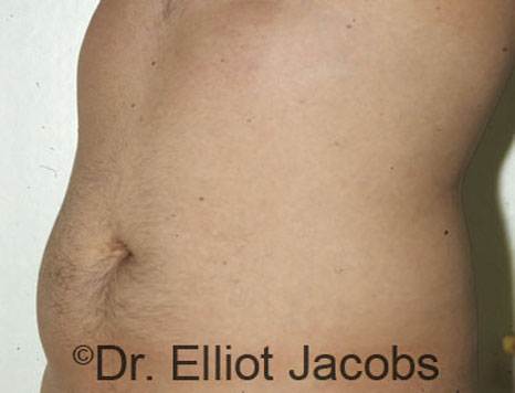 Male body, before Torsoplasty treatment, l-side oblique view, patient 3