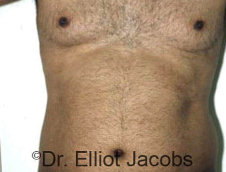 Male body, before Torsoplasty treatment, front view, patient 4