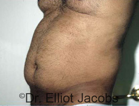 Male body, before Torsoplasty treatment, l-side oblique view, patient 4