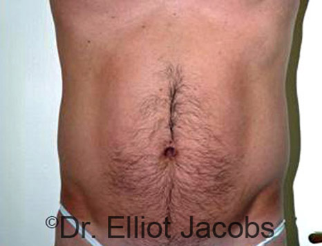 Male body, before Torsoplasty treatment, front view, patient 5