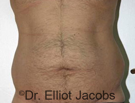 Male body, before Torsoplasty treatment, front view, patient 6