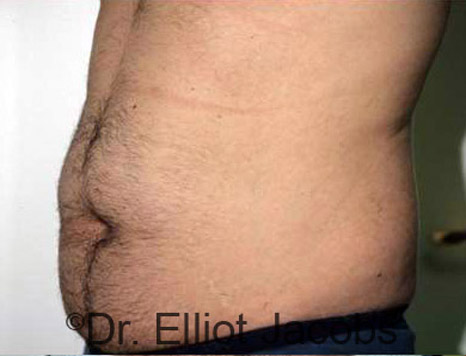 Male body, before Torsoplasty treatment, l-side oblique view, patient 6