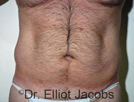 Male body, before Torsoplasty treatment, front view, patient 7