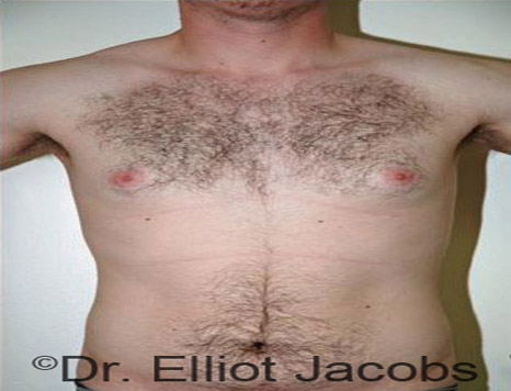 Male body, before Torsoplasty treatment, front view - patient 7