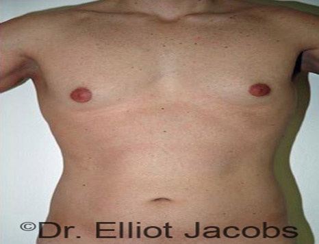 Male body, before Torsoplasty treatment, front view, patient 8
