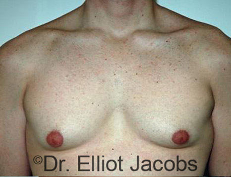 Male body, before Torsoplasty treatment, front view - patient 8