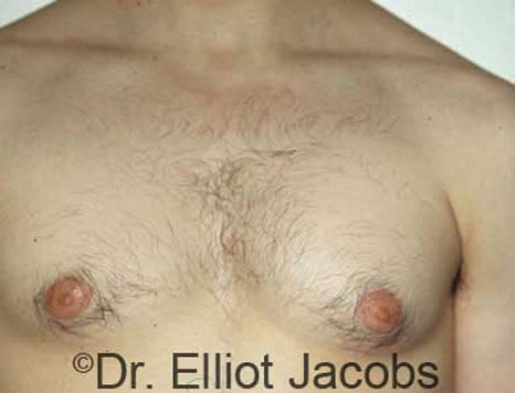 Male breast, before Gynecomastia treatment, front view, patient 14