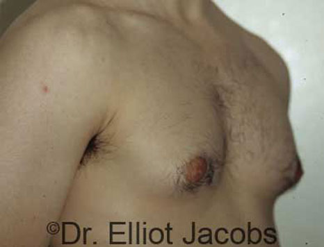 Male breast, before Gynecomastia treatment, r-side oblique view - patient 14