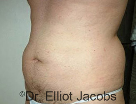 Male body, before Torsoplasty treatment, l-side oblique view, patient 9