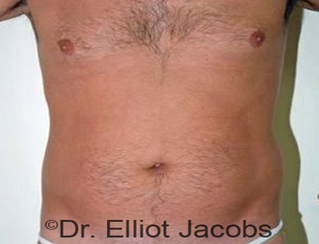 Male body, before Torsoplasty treatment, front view, patient 10