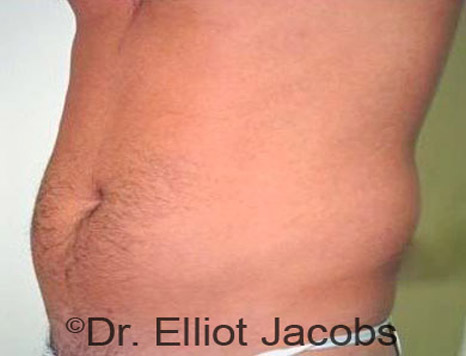 Male body, before Torsoplasty treatment, l-side oblique view, patient 10
