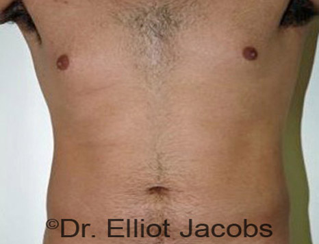 Male body, before Torsoplasty treatment, front view, patient 11