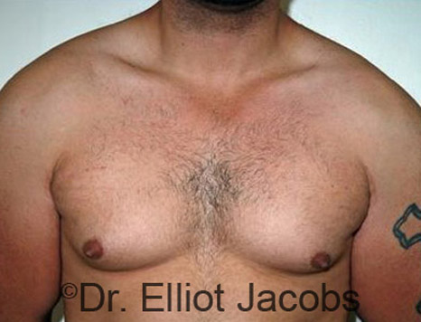 Male body, before Torsoplasty treatment, front view - patient 11