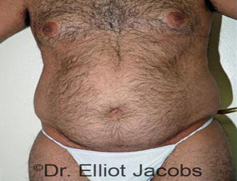 Male body, before Torsoplasty treatment, front view, patient 12