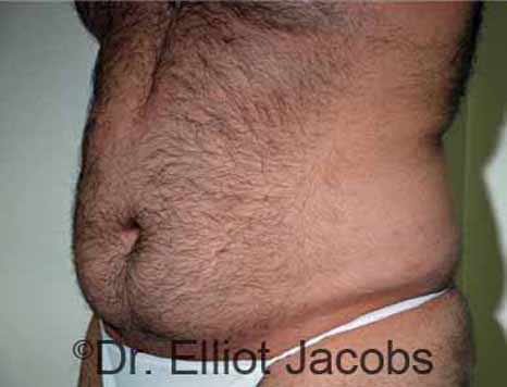 Male body, before Torsoplasty treatment, l-side oblique view, patient 12