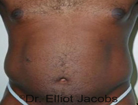 Male body, before Torsoplasty treatment, front view, patient 13