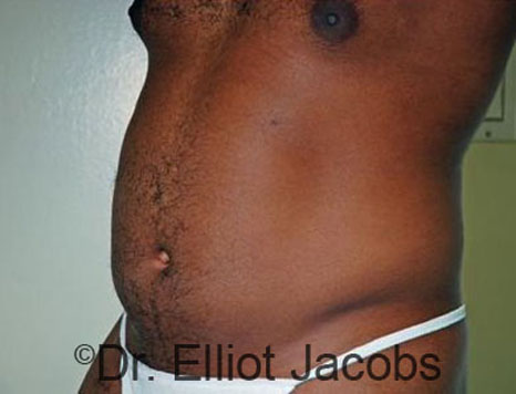 Male body, before Torsoplasty treatment, l-side oblique view, patient 13