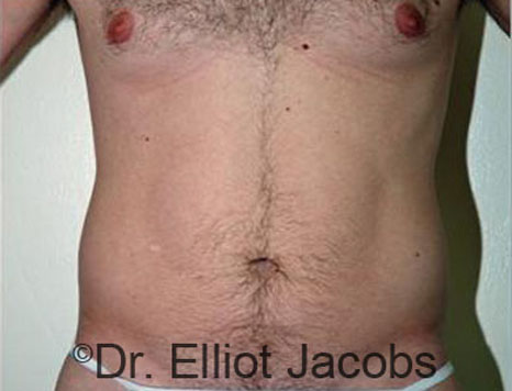 Male body, before Torsoplasty treatment, front view, patient 14