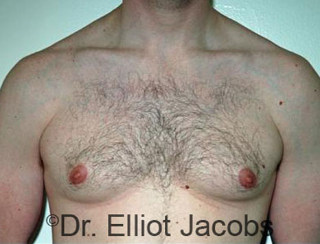Male body, before Torsoplasty treatment, front view - patient 14