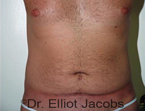 Male body, before Torsoplasty treatment, front view - patient 3