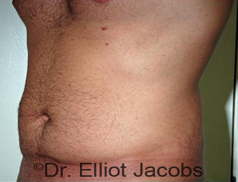 Male body, before Torsoplasty treatment, l-side oblique view, patient 15