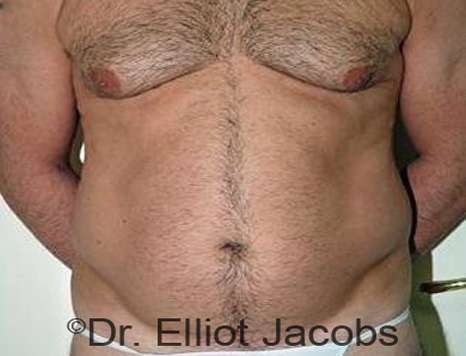 Male body, before Torsoplasty treatment, front view, patient 16