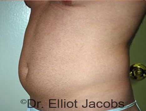 Male body, before Torsoplasty treatment, l-side oblique view, patient 17
