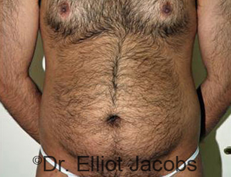 Male body, before Torsoplasty treatment, front view, patient 18