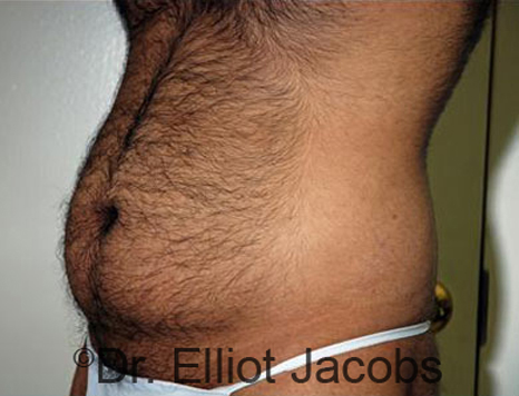 Male body, before Torsoplasty treatment, l-side oblique view, patient 18