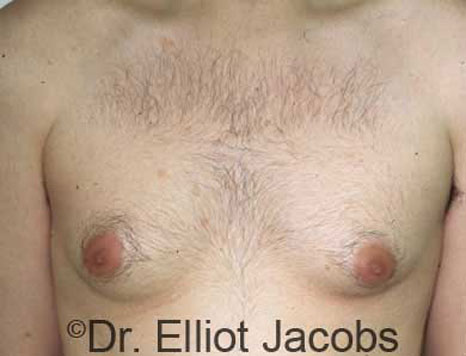 Male breast, before Gynecomastia treatment, front view, patient 1